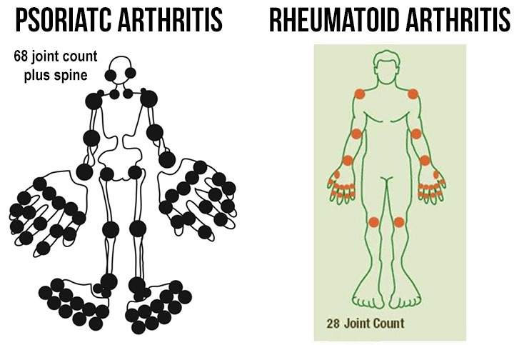 Psoriatic Arthritis v Rheumatoid Arthritis